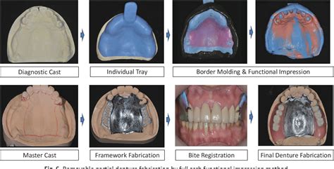 removable partial denture steps